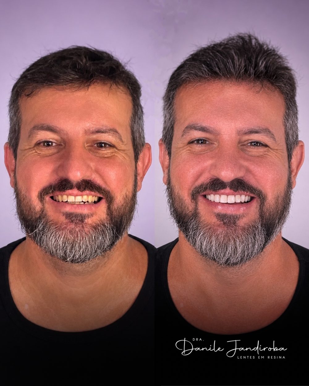 Antes e depois de um sorriso masculino: à esquerda, dentes antes do tratamento; à direita, depois das lentes em resina