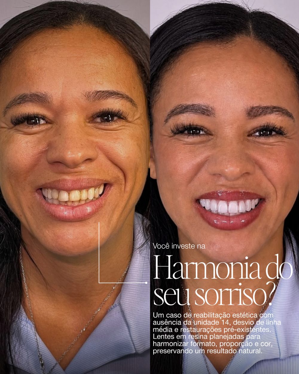 Antes e depois de uma paciente: à esquerda, sorriso antes do tratamento; à direita, depois das lentes em resina. Texto na imagem: Você investe na harmonia do seu sorriso?