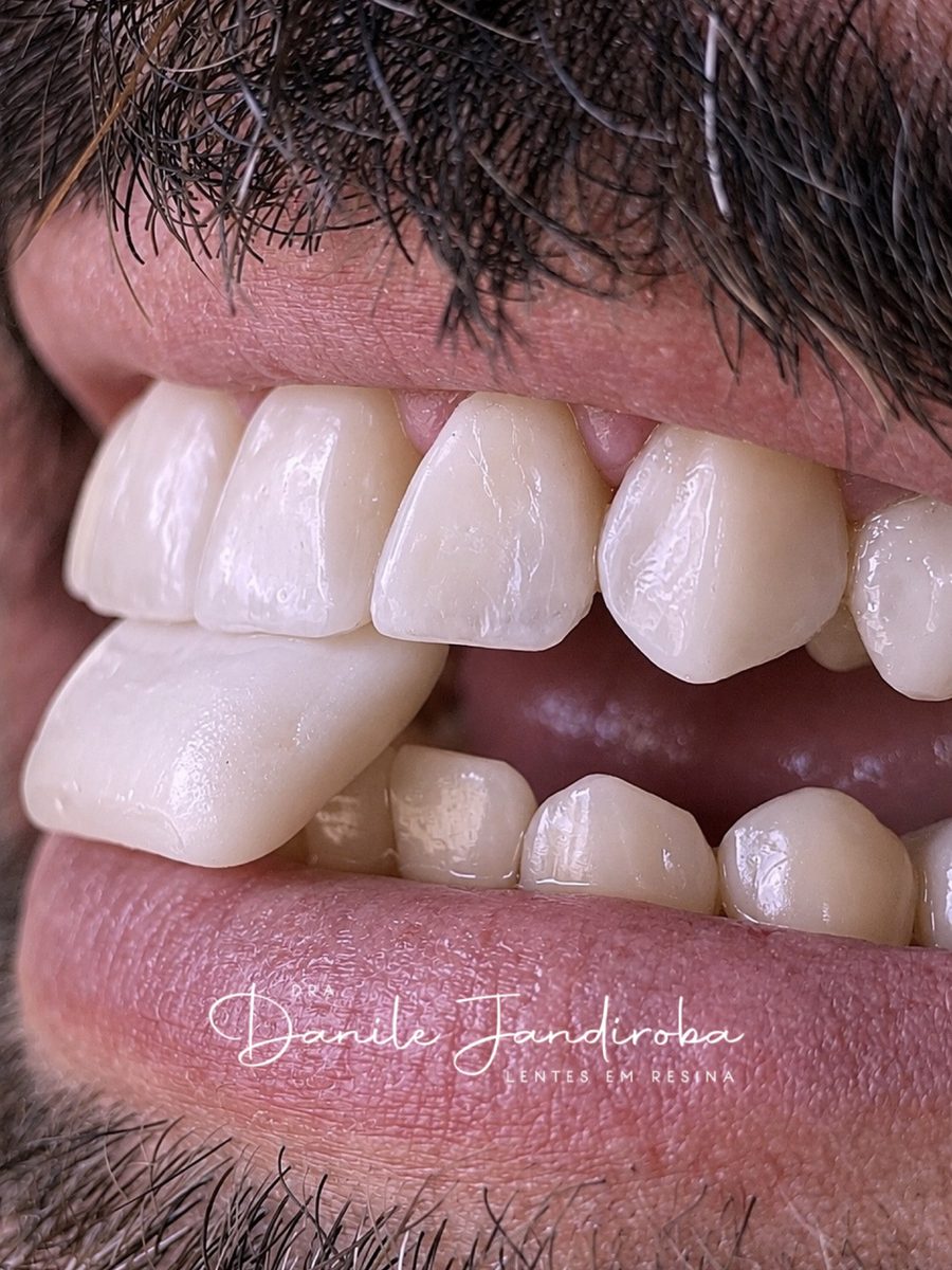 Close dos dentes da frente em vista lateral